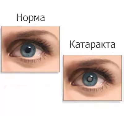 лечение катаракты