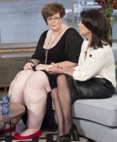 Редкое заболевание раздуло ноги женщины до 63 килограммов