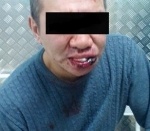 В Якутии жестоко избили спортсмена-инвалида