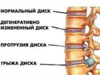 Что такое протрузия диска