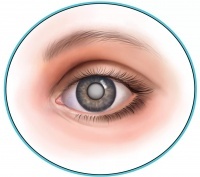 Запотевшее стекло нашего глаза – катаракта.