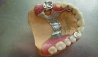 Современные зубные протезы. Какие лучше поставить, виды и сравнения.