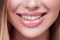 Современные методы отбеливания зубов