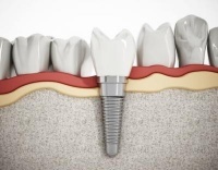Материалы для имплантации зубов