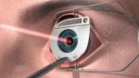 Лазерная коррекция зрения. Характеристика, показания и противопоказания к лазерной коррекции зрения.