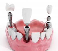 Имплантация зубов - основные особенности.