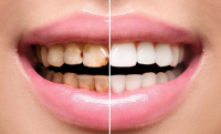 Реставрация зубов: Восстановление эстетической и функциональной природы зубов