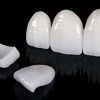 Про протезирование зубов
