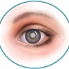 Запотевшее стекло нашего глаза – катаракта.