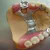 Современные зубные протезы. Какие лучше поставить, виды и сравнения.