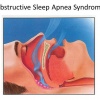 Апноэ во сне - симптомы, диагностика и лечение