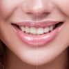 Современные методы отбеливания зубов
