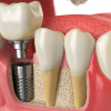 Зубная имплантация: постоянное решение проблемы отсутствия зубов