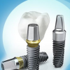 Имплантаты для зубов: Современные решения для естественного восстановления улыбки