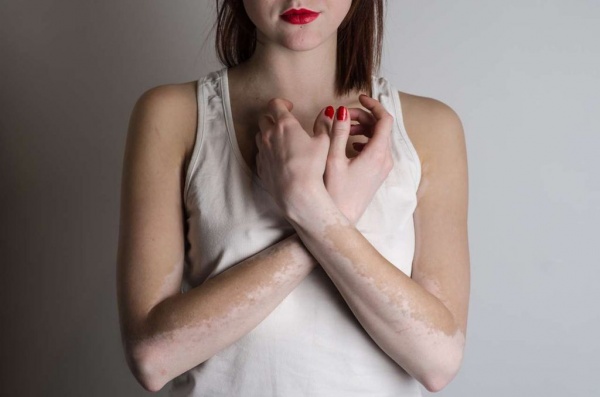 https://vitimed.ru/vitiligo/maz-ot-vitiligo-kakuyu-vybrat/